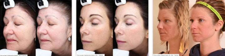 Laser Skin Rejuvenation Results in Fairfield, CT