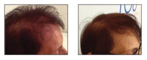 hair loss treatment fairfield ct