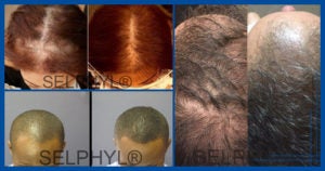 PRFM-Before-and-After-hair-restoration