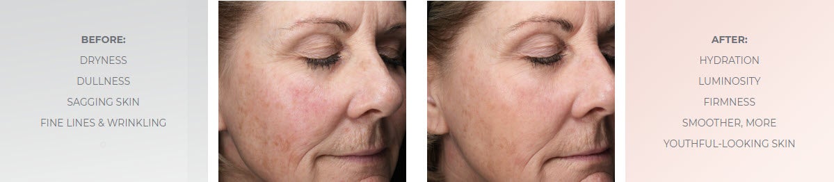 emepelle serum results