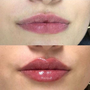 Hyapen Pro Lip Filler Results in Fairfield, CT