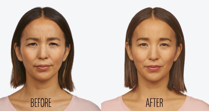 Jeuveau Newtox Before After Results at All About You Medical Spa