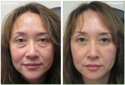 Microneedling pen eyelid treatment results fairfield ct