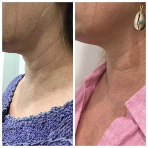 Plasma Pen Skin Rejuvenation Treatment Results Fairfield Ct
