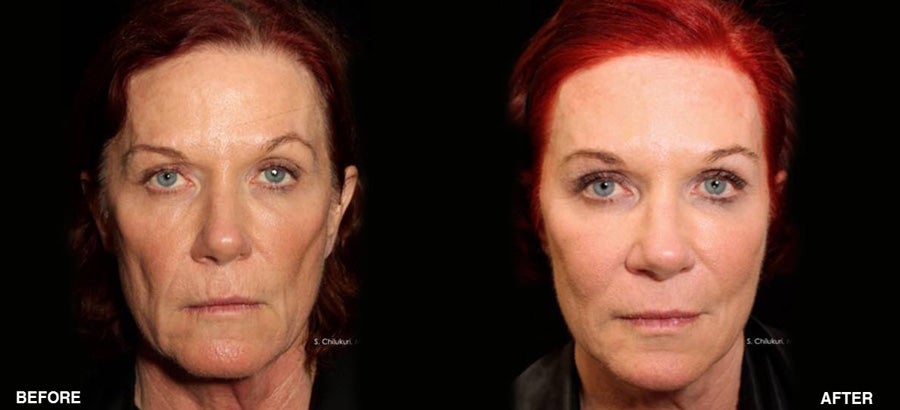 Silhouette InstaLift™ Non-Surgical Facelift fairfield ct results