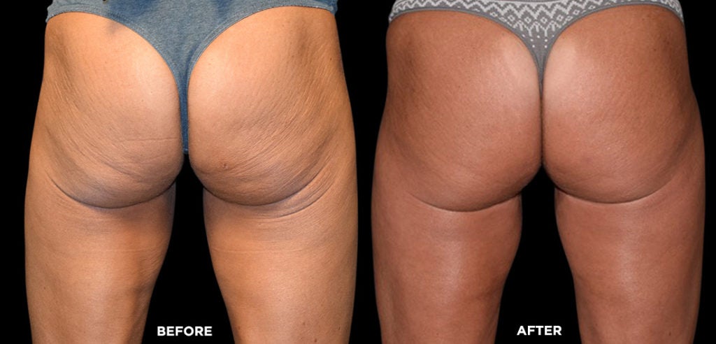 Emsculpt, a Non-Invasive Butt Lift Treatment in Fairfield, CT