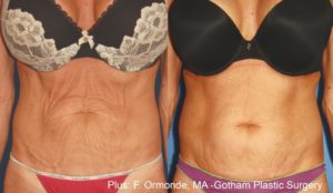 evolve before and after results