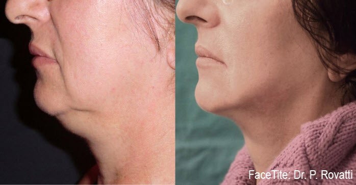 Facetite Nonsurgical Facelift Results in Fairfield, CT