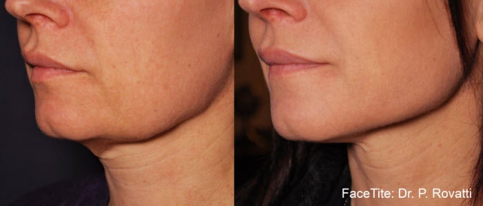 facetite before after results
