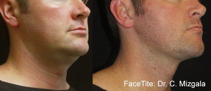 facetite nonsurgical facelift before after results