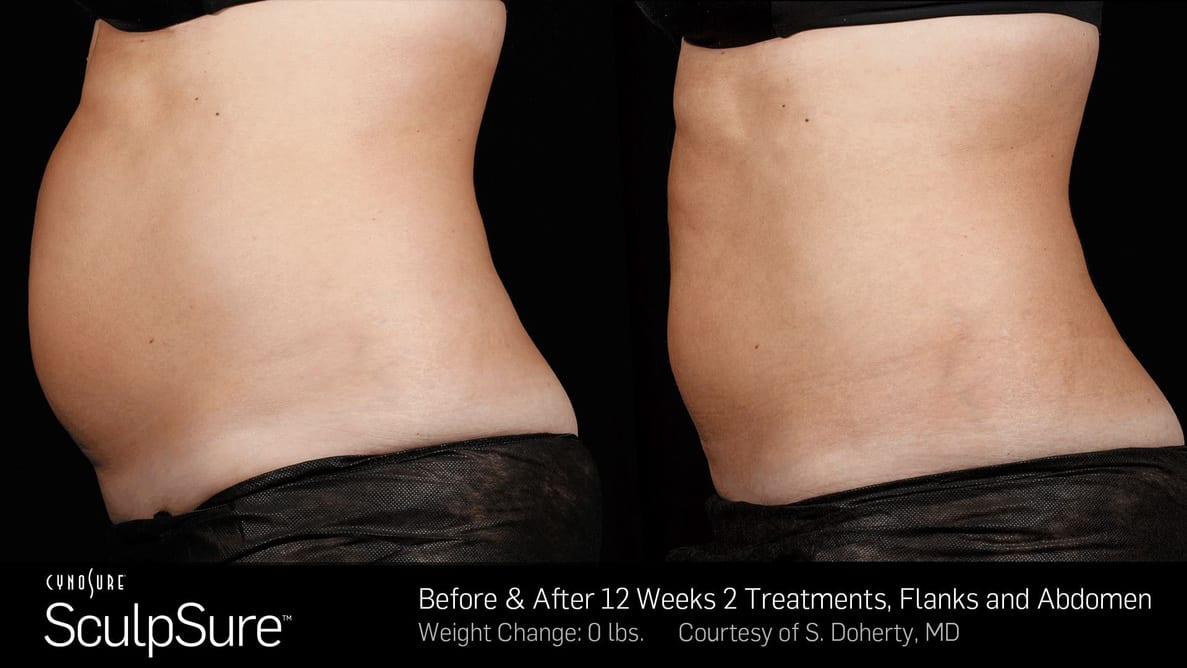 SculpSure Treatment