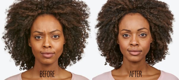 Jeuveau™ Treatment Before After Results by All About You Medical Spa