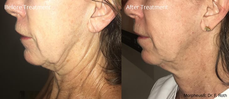 Morpheus8 RF Micro-Needling Treatment in Fairfield, CT