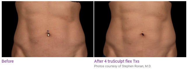 trusculpt flex before after results