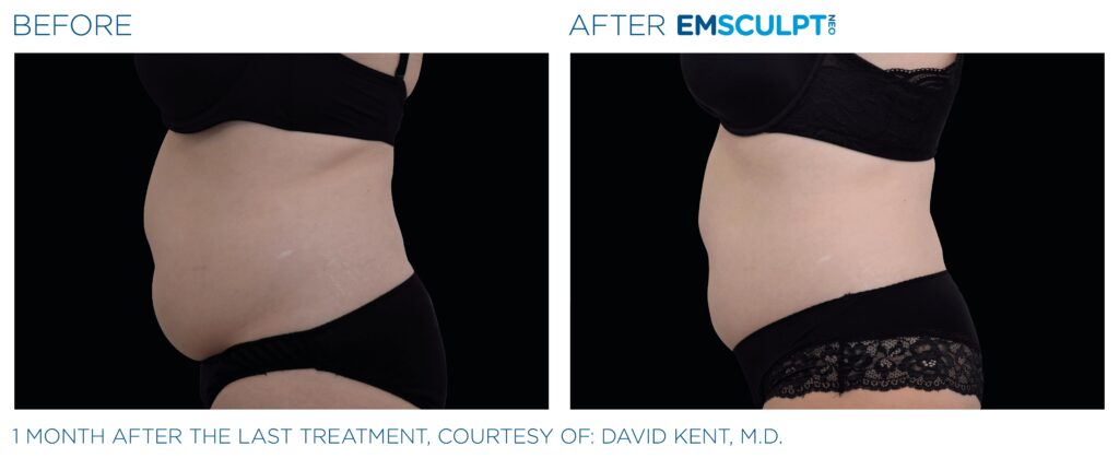 emsculpt neo abdomen before and after