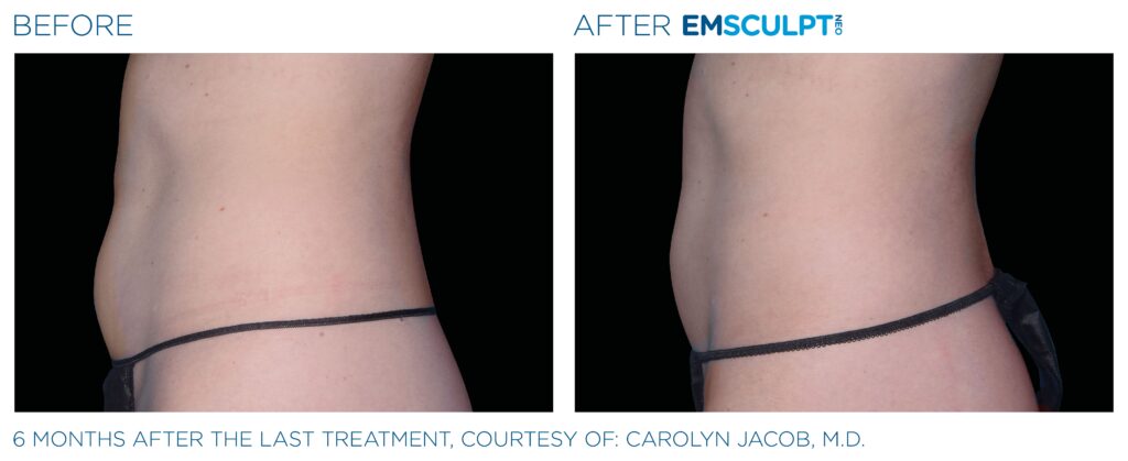 female abdomen results with emsculpt neo