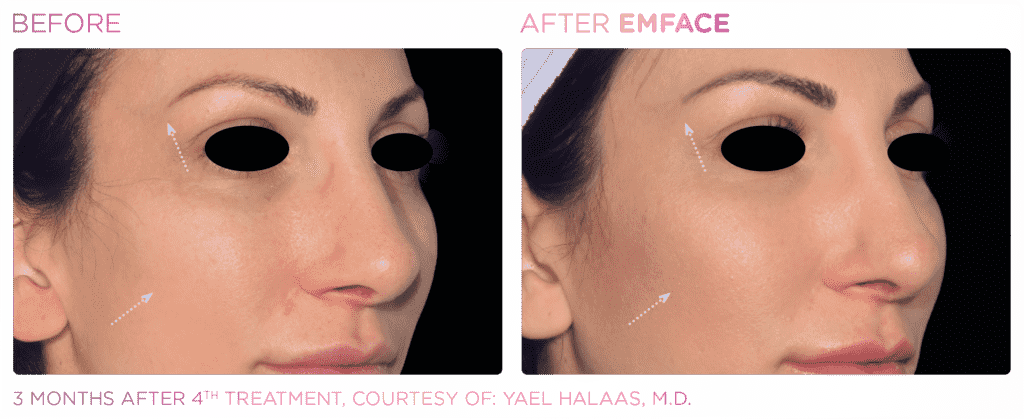 Before & After Emface Facial Toning Treatment in Fairfield, CT