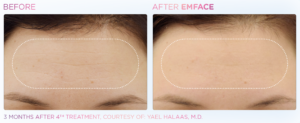 Before & After Emface Forehead Treatment in Fairfield, CT