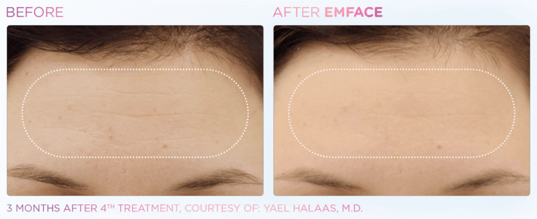 Before and After EMFACE Treatments in Fairfield, CT
