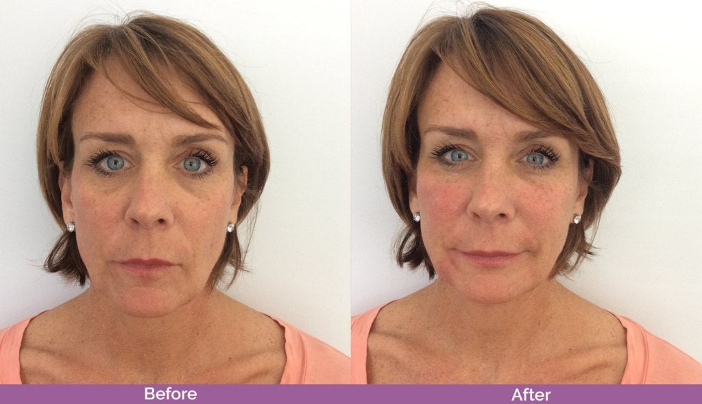 juvederm-voluma-before-and-after