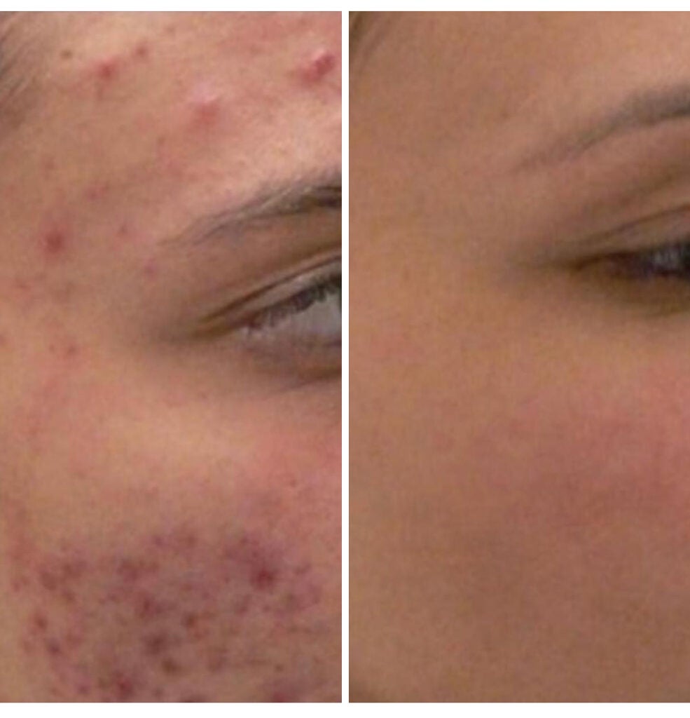 Halo Before & After