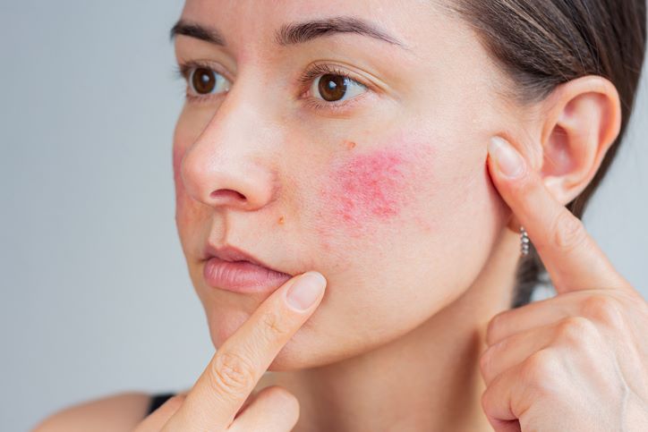 Calm Redness with Rosacea Treatment in Fairfield, CT
