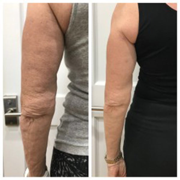 Arms before and After