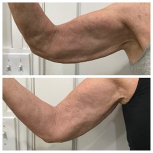 Arms before and After