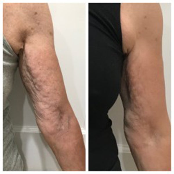 Arms before and After