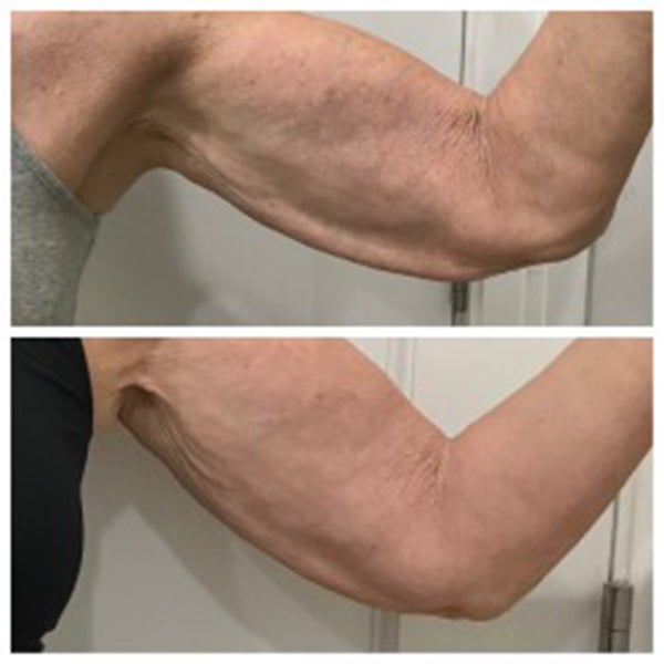 Arms before and After