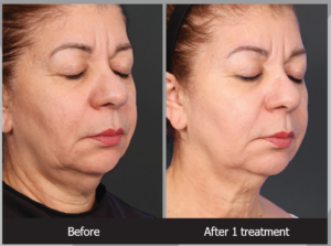 Before and After Xerf