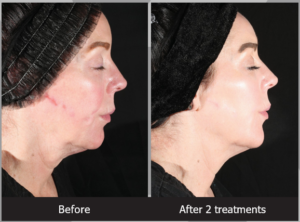 Before and After Xerf