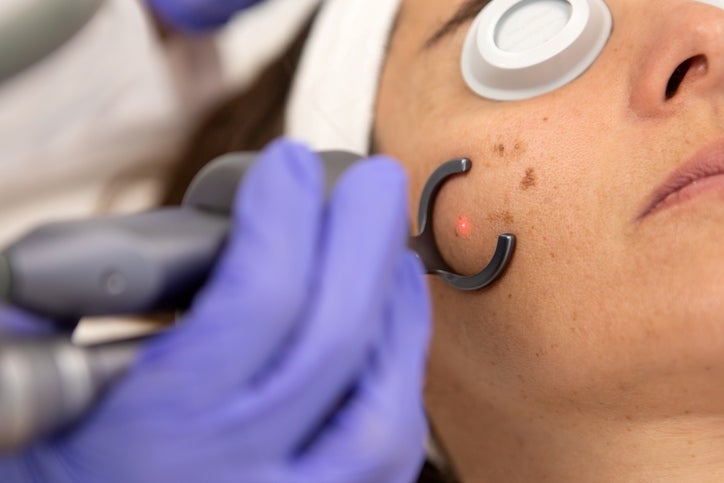 Dark Spot Removal in Fairfield, CT