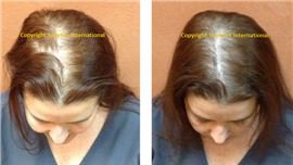 Sunetics Laser Hair Loss Treatment