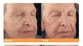 Smartskin Treatment Results