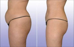 Belly fat burner treatment by All About You Medical Spa in Fairfield, CT