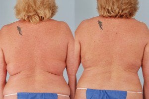 Laser body sculpting results before & after