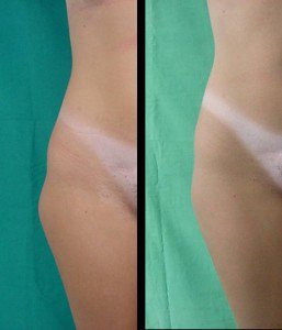 Laser Body Sculpting treatment in Fairfield, CT