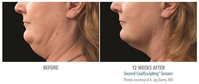 coolmini double chin removal results: Before & After