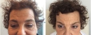 Hair Growth treatment results : Before & After in Fairfield, CT