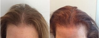 Hair loss treatment results: Before & After in Fairfield, CT