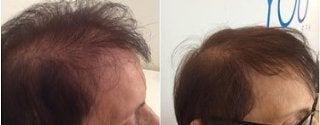 Hair growth before and after treatment results in Fairfield, CT