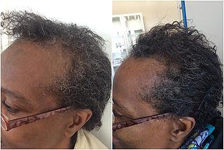 Hair Treatment Results: Before & After in Fairfield, CT