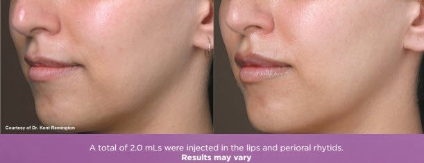 Juvéderm Volbella® lip injection results fairfield ct