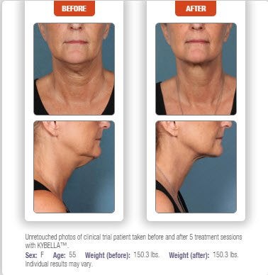 Kybella Double Chin treatment before & after results