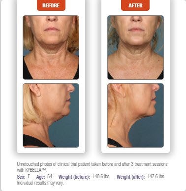 Before & After Kybella treatment results