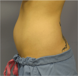 Laser body sculpting treatment results: Before & After