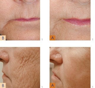 Laser antiaging treatment result before & after