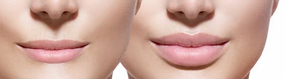 Lip enhancement treatment results by specialists at All About You Medical Spa in Fairfield CT.