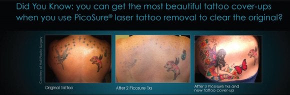 tattoo removal fairfield ct